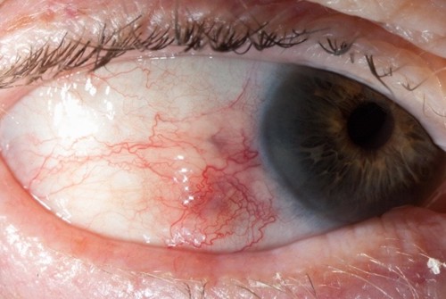 Herpes zoster ophthalmicus - nzoptics