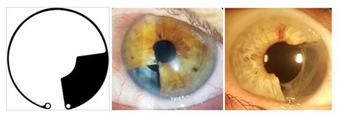 Contemporary surgical managment of iris tumours and reconstruction ...